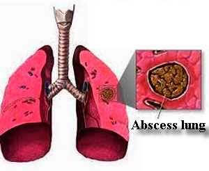 Lung Abscess