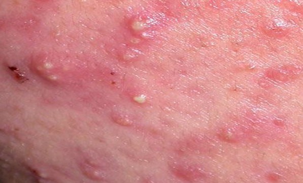 Acne vulgaris