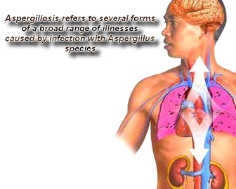 Aspergillosis