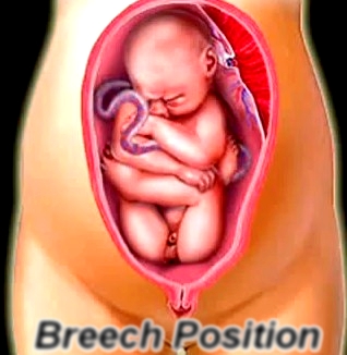 Breech Position