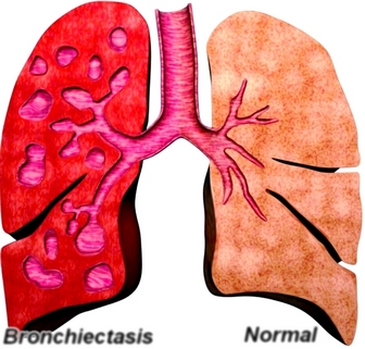 Bronchiectasis