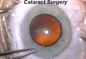 Cataract Surgery