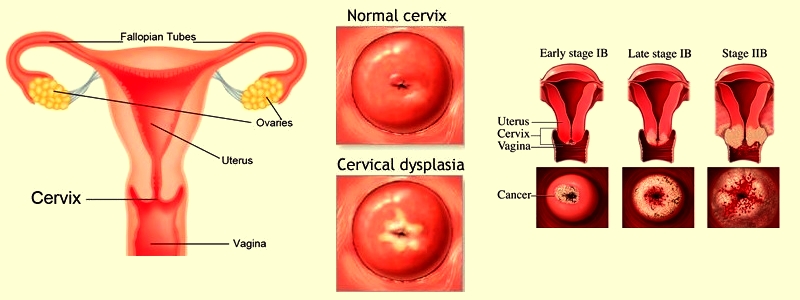 Cervical dysplasia