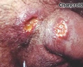 CDC - Diseases Characterized by Genital, Anal, or Perianal ...