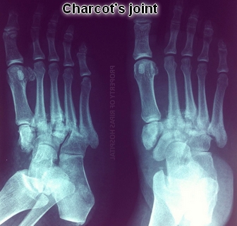 Charcot’s joint