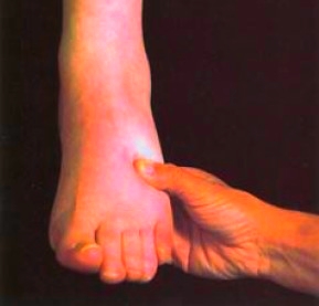 Edema of the foot