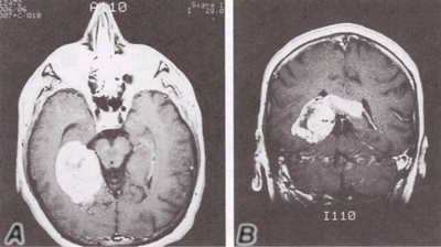 Glioblastoma multiforme