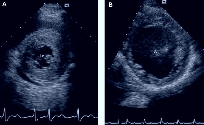 Hypertrophic and dilated cardiomyopathy