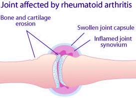 Juvenile rheumatoid arthritis