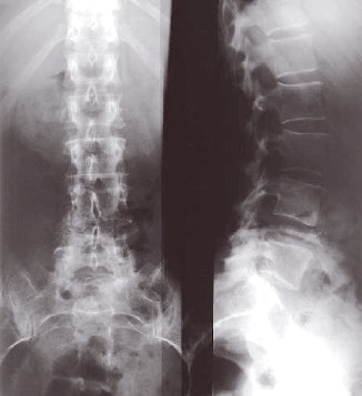 Osteolytic metastasis with pathological fracture of the vertebral body