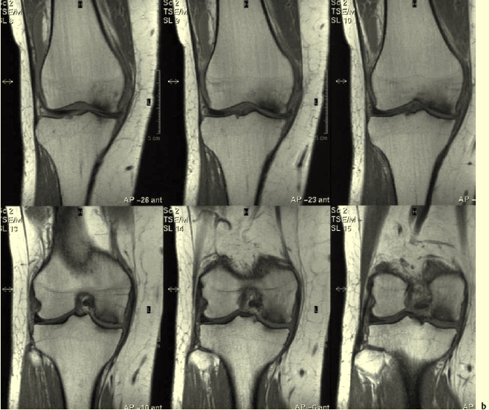 Osteonecrosis of the medial femoral condyle