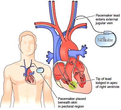 Placement of an artificial pacemaker