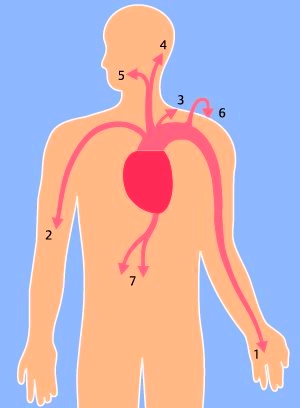 Radiation of angina pectoris