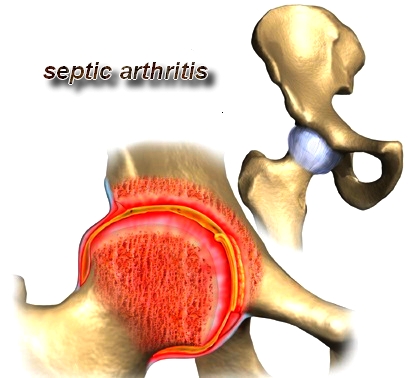 Septic arthritis