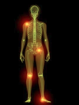 Septic arthritis