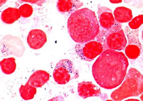 Sideroblastic Anemia