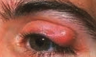 inflammation of the eyelids