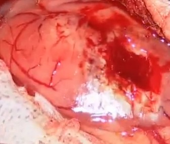 low grade astrocytoma