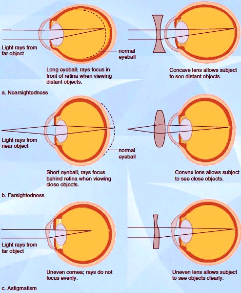 Common abnormalities of the eye with possible corrective lenses