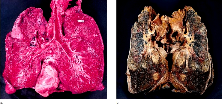 Normal lung versus cancerous lung