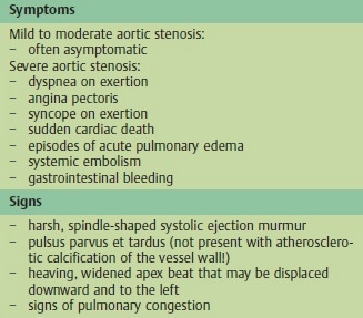 Aortic Stenosis. Symptoms and Signs of Aortic Stenosis
